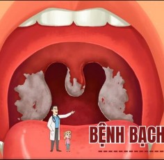 Bệnh bạch hầu là gì? Phương pháp điều trị an toàn, hiệu quả